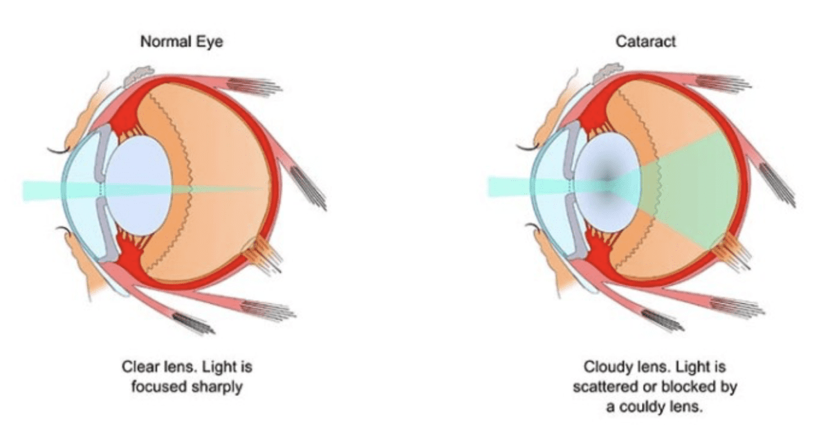 Dog cataract diagram